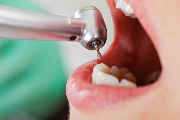 Best Emergency Tooth Extraction in Blountville, TN